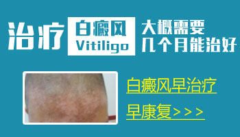 白癜风照光几个疗程有效果