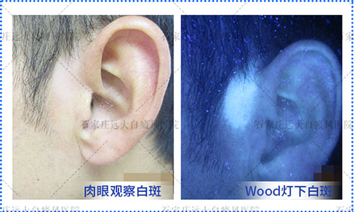 激光点痣一年多后变白斑怎么回事