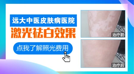 激光治疗白癜风效果好 白斑照光收费价格表