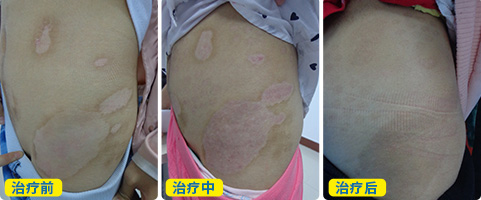 紫外线光疗治白癜风怎么样 有哪几种光疗