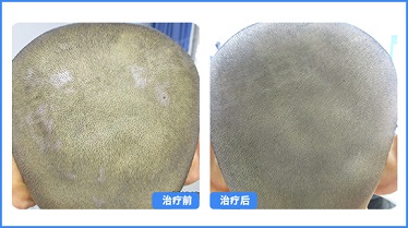 小孩头部有些小白点点是怎么了