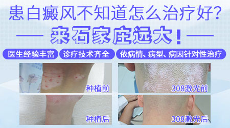  白癜风扩散的部位和面积大小有什么规律