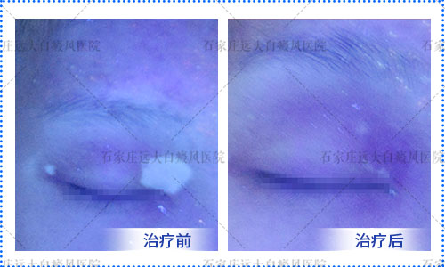 眼睛部位白癜风图片