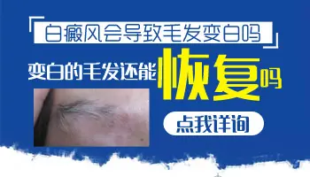 白癜风眼睫毛白怎么治