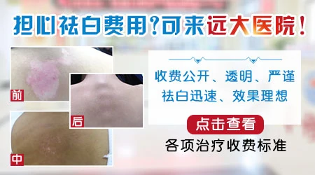 一般白癜风治疗需要花多少钱