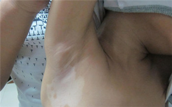腋窝下出现白色斑块是什么皮肤病