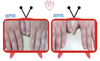 手上长个小白点是啥 白点是白癜风吗