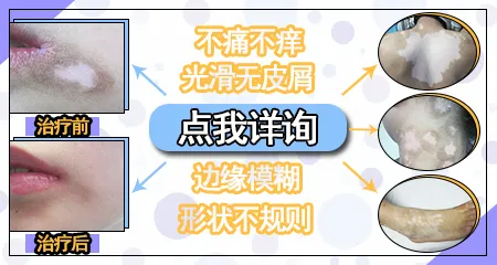 早期白癜风白斑边缘是清晰还是模糊的