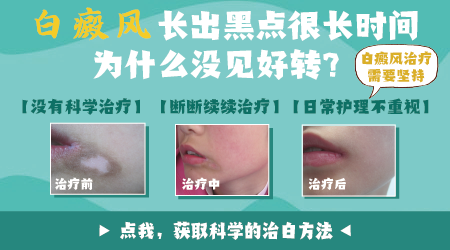 白癜风患处发痒发红是在好转吗