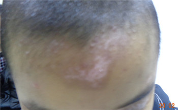 怎么看白斑是虫斑还是白癜风