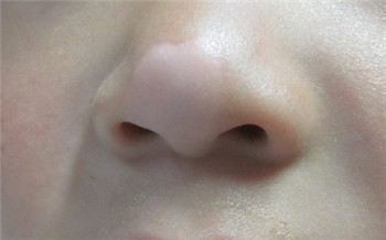 孩子鼻梁中间发白是什么病