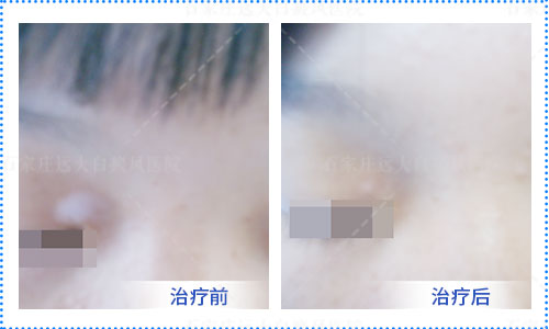 治白癜风祛白酊和复方卡力孜然酊怎么选择