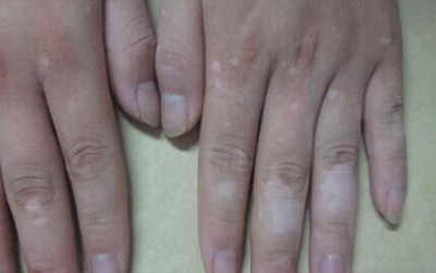 手指关节处长白斑 手指白斑图片对比