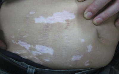 腰部有一块白斑不是很明显怎么回事