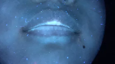 嘴唇白癜风初期照片