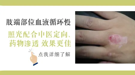 手指关节处的白斑照308激光能照好吗