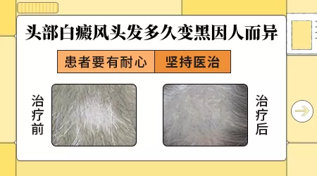 白癜风好了旁边白色毛发多久能好