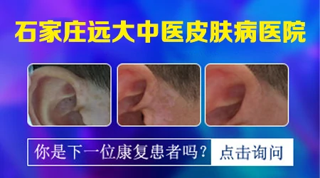 河北白斑医院 河北治白斑专业医院