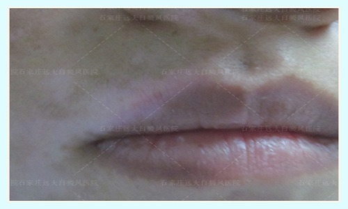嘴唇白癜风初期图片