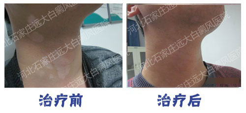 白癜风照激光贵吗 308激光治疗白癜风收费