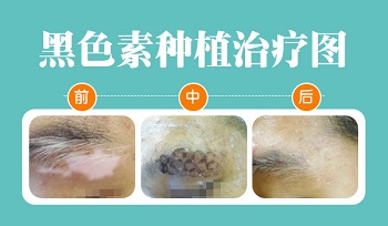 稳定期白癜风黑色素种植后皮肤图片