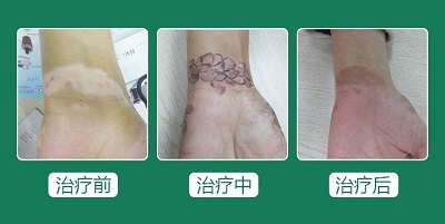 白癜风移植三伏天可以做吗