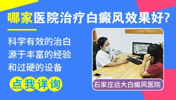 火针治疗白癜风后要擦什么药膏