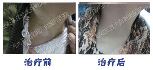 我都治好了白癜风 你要不要也试试