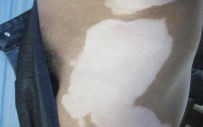 大腿内侧有大片白色皮肤是不是白癜风