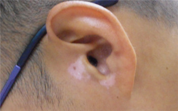 宝宝白斑图片 有白斑不会是白癜风吧