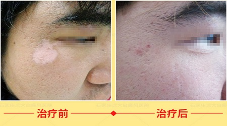 眉毛周边的白斑照了308眉毛会掉吗