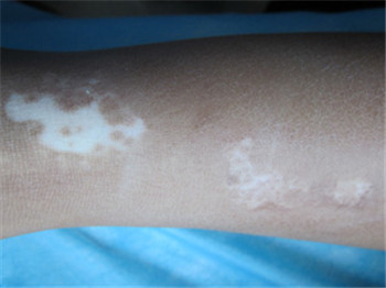 孩子胳膊有小块白色