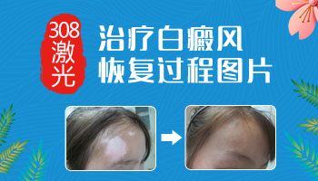 保定治疗白癜风都用什么方法