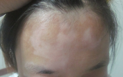 女性额头发际线的位置发现一块黄豆粒大小的白斑