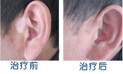 治疗白癜风的仪器