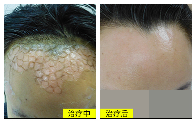 面部白癜风植皮手术对比图