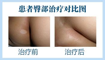 白癜风做308激光肤色会恢复正常吗