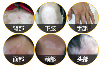 芝麻大小的白点是白癜风早期症状吗