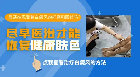 腿上长白癜风可以不军训吗