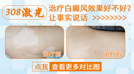 肩部白癜风早期症状图片