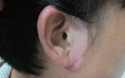 耳朵旁边的皮肤不均匀有点白是怎么回事