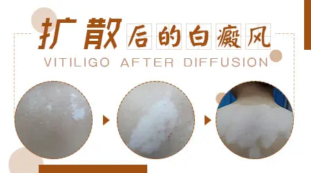 不治疗的话白斑ZUI终会扩散成什么样图片