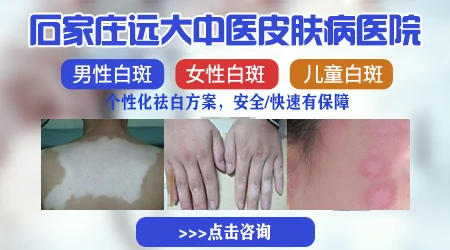 孩子腰上大片白斑图片