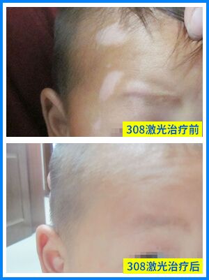 婴儿身上长了几块白斑的原因是什么