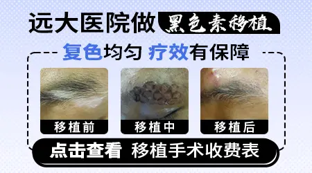 石家庄哪里能做表皮移植治白癜风