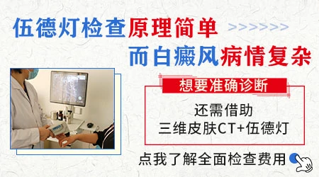 伍德灯能确诊白癜风吗 白癜风什么样