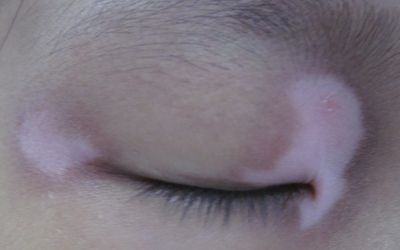 婴儿眼睛周围一圈皮肤发白什么原因