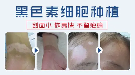肢端部位的白癜风白斑复色难度大吗