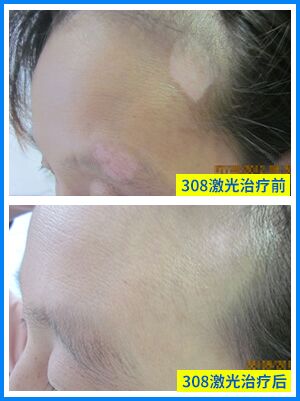 家用照光仪照孕妇白癜风可以照吗