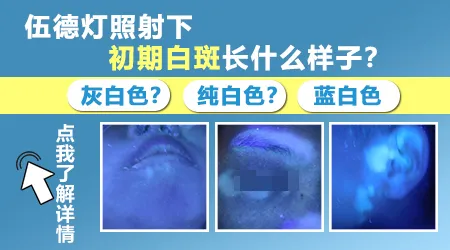 伍德灯下白癜风早期图片